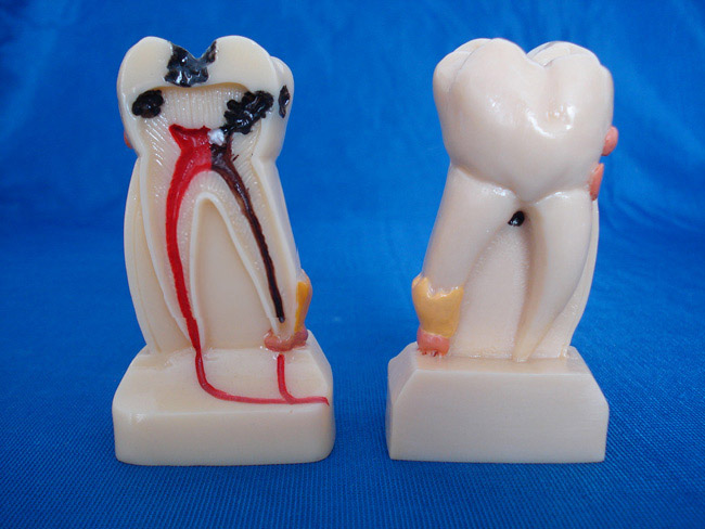 4倍牙体综合病理模型