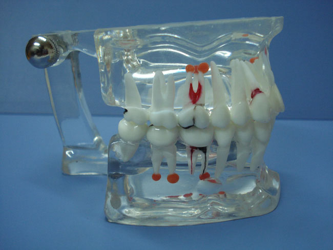 综合病理水晶牙列模型(28颗牙)