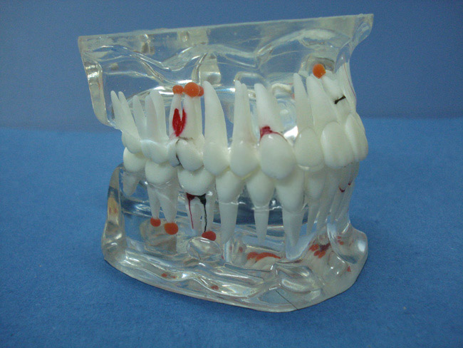 综合病理水晶牙列模型(28颗牙)