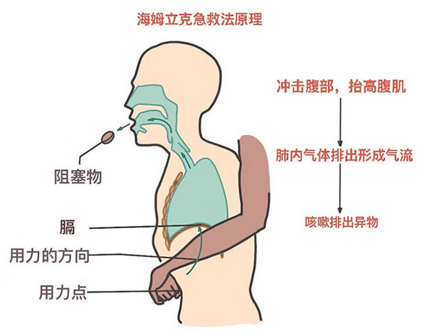 成人海姆立克示意图