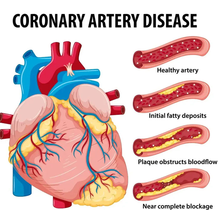 心脏血管狭窄阻塞图